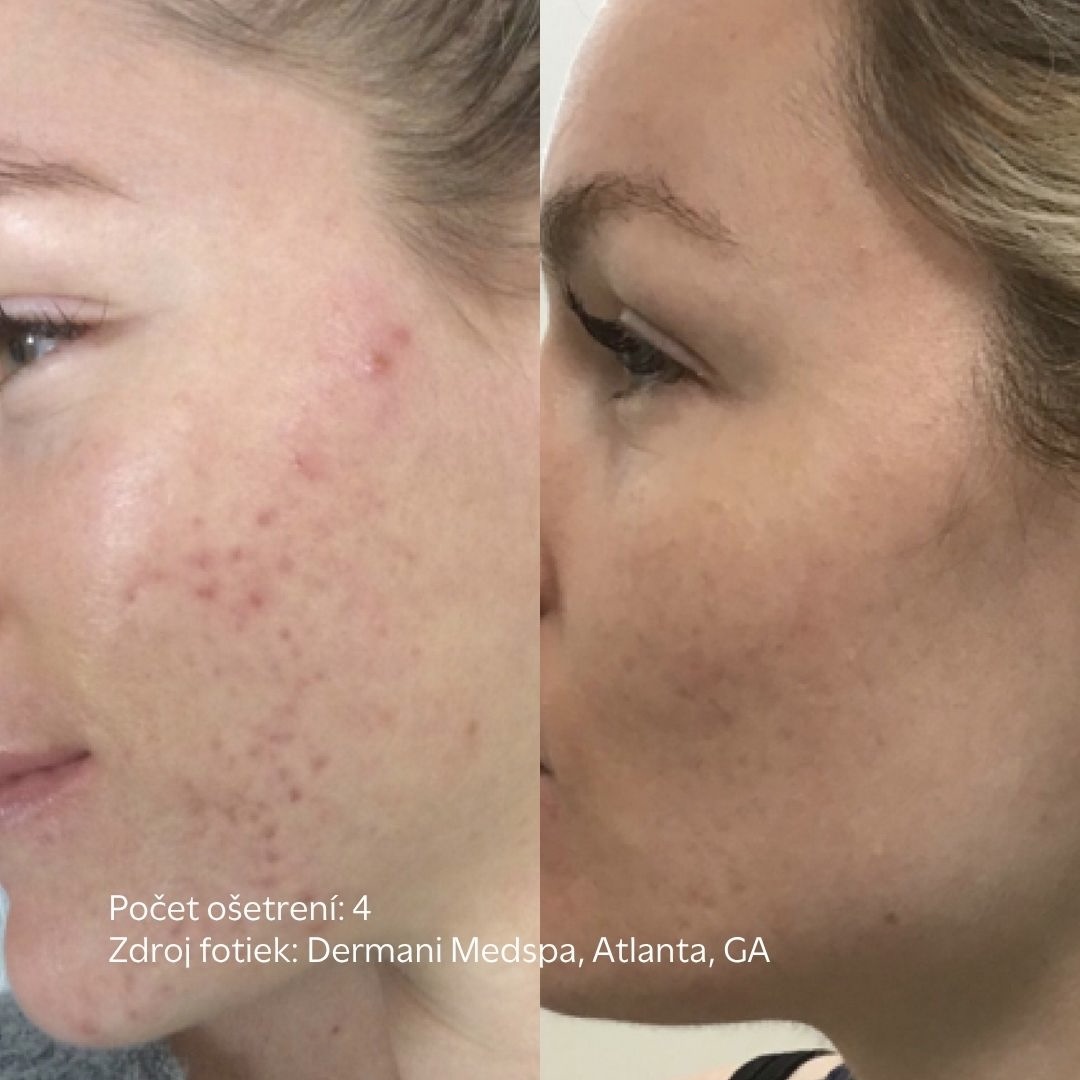 tvar po procedure skinpen - pred a po vo facederma klinike