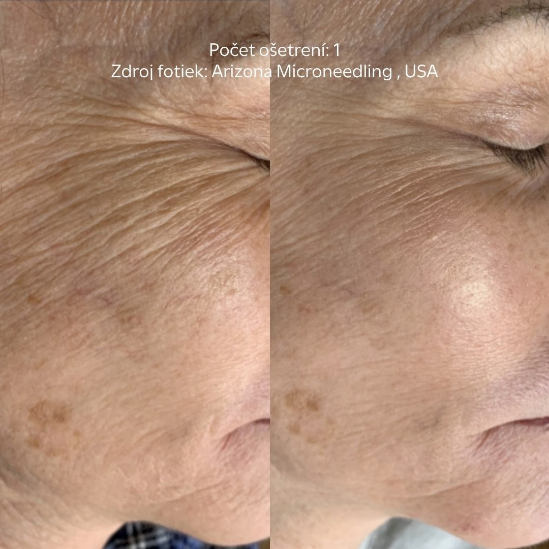 procedura skinpen - pred a po