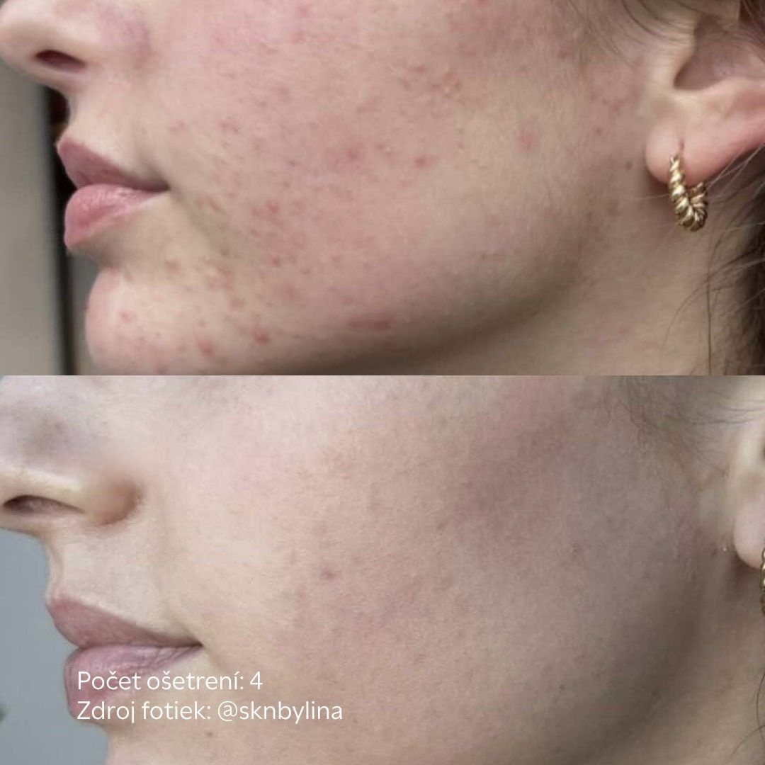 tvar s akne po procedure skinpen vo facederma klinike