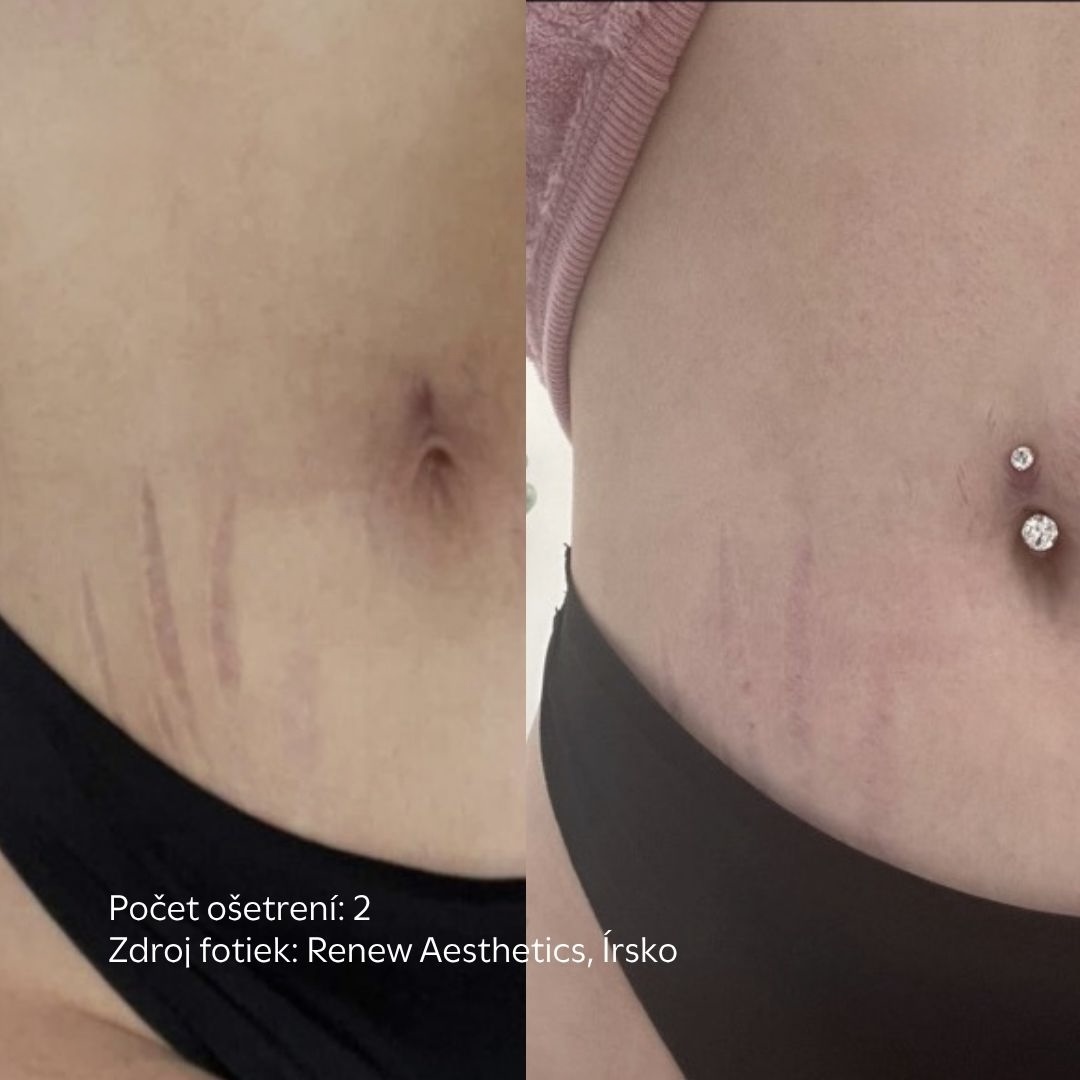 strie po procedure skinpen vo facederma klinike